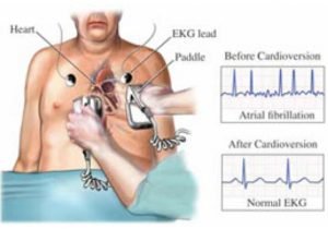 Cardioversion - Mildura Cardio